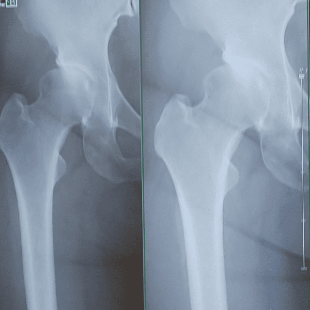 貧乏ゆすりで股関節の軟骨を再生する方法とその効果