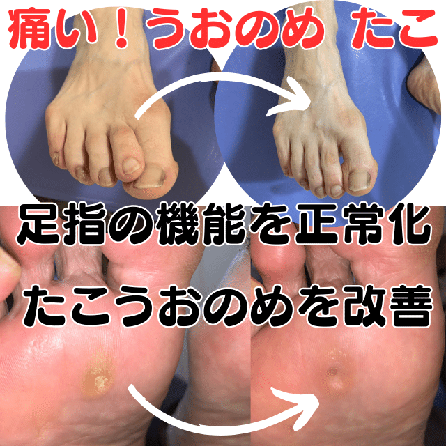 足裏のタコは足指の機能低下（配列異常）が原因かも？