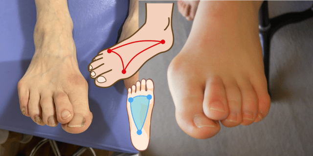足裏のタコは足指の機能低下（配列異常）が原因かも？