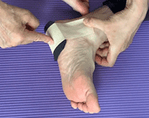 足底筋膜炎のテーピングクッション法