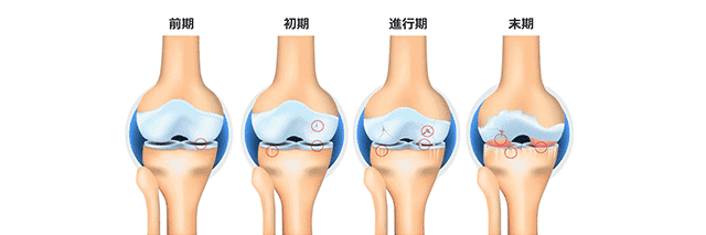変形性膝関節症の悪化レベル
