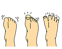 足指の機能回復の運動