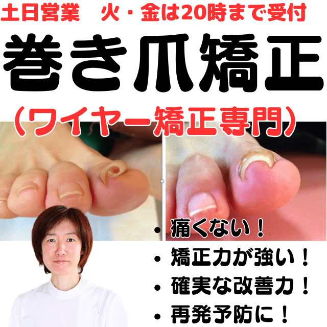 巻き爪ワイヤー矯正