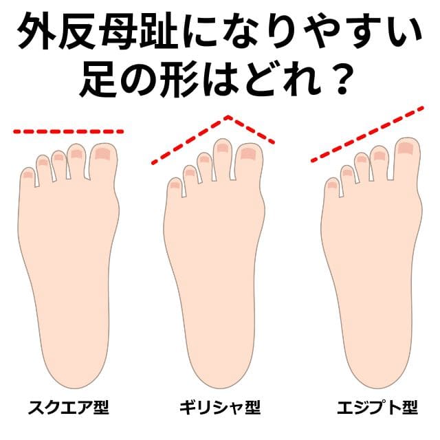 外反母趾になりやすい足形とは？|さいたま中央フットケア整体院